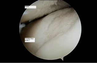 görünüm astroscope üzerinde diz eklemi ile osteoartrit 3. derece