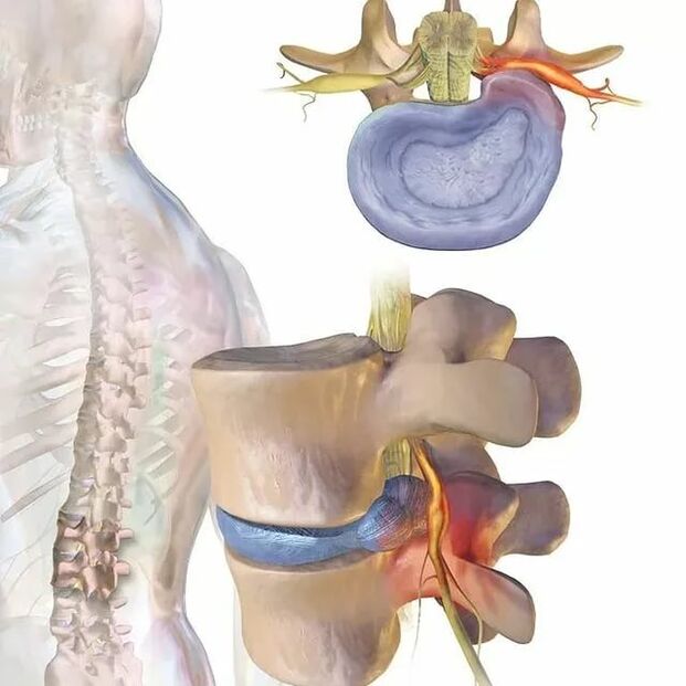 intervertebral disk problemleri