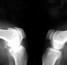 Osteoartrit x-ray