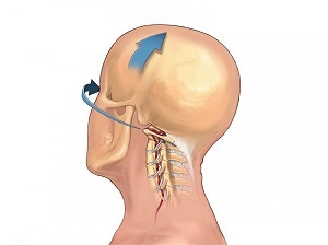 servikal omurganın osteokondrozu kendini nasıl gösterir