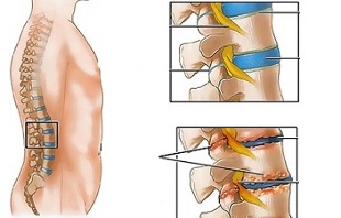 lomber omurganın osteokondrozunun nedenleri