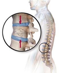 Osteoporoz lomber bölgede sırt ağrısına neden olur